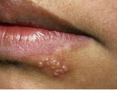 oral herpes treat cold sores